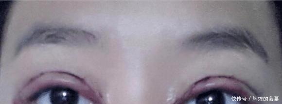 手术|做过双眼皮手术的年轻人,老了以后眼睛会怎么样看来是这个道理!