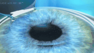 生物力学|淄博康明爱尔眼科医院：全飞秒和半飞秒的区别