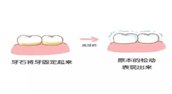 牙周病|牙齿松动 不是洗牙“惹的祸”