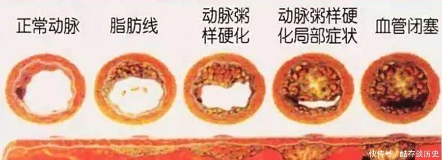 凶险夺命的冠心病，首要的危险因素就是高血压