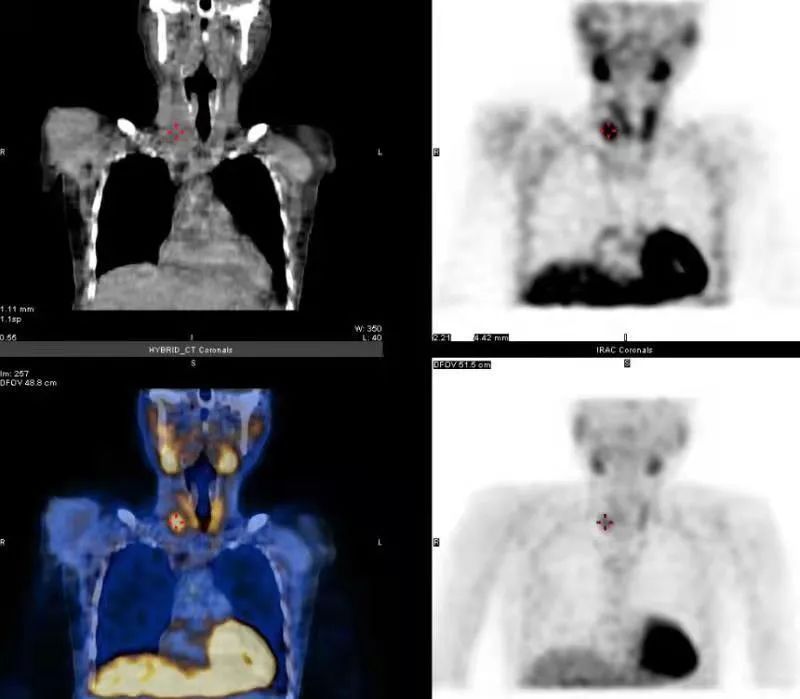 甲状旁腺|这个存在感低的体检项目,忽视可能致命!