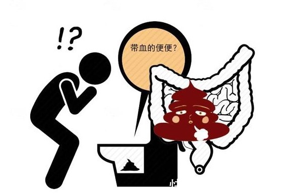 身体|肠癌一发现就是晚期?医生:身体有4种“异常”,是肠道“求救”