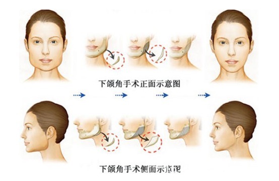 下颌角 下颌骨手术后多久能消肿呢？术后护理注意事项有哪些？