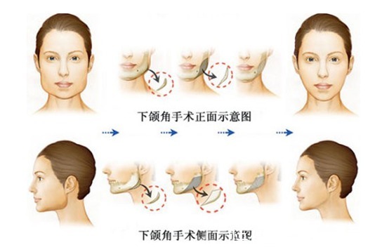 下颌角 下颌骨手术后多久能消肿呢?术后护理注意事项有哪些?
