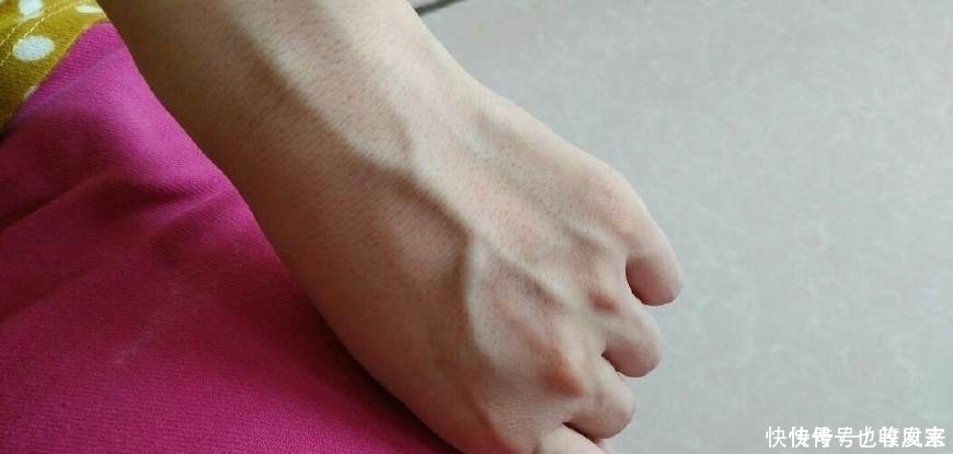 肝好的人,手上可能有3个“记号”,若发现一个,恭喜,肝较健康