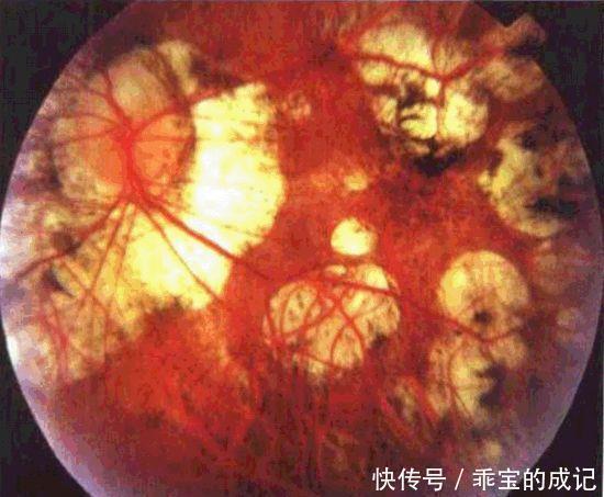 玻璃膜|近视超过600+？我建议你看看自己的眼底，绝对惊恐！