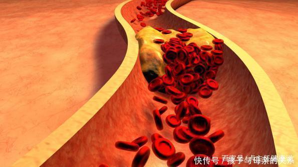 医生|1种零食,正在悄悄“堵塞”你的血管,医生忠告:再喜欢也要少吃