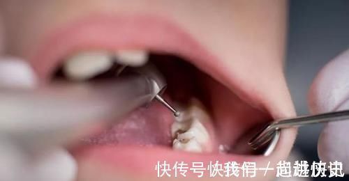 牙齿|不想孩子一口烂牙,这些坑可要避开了,家长多上心