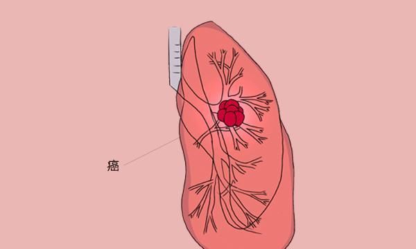 肺部问题,生活小细节你不容忽视,如果症状开始出现,得尽早就医