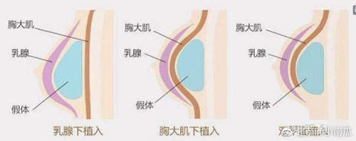 担心假体隆胸会移位，如何防止假体隆胸移位？