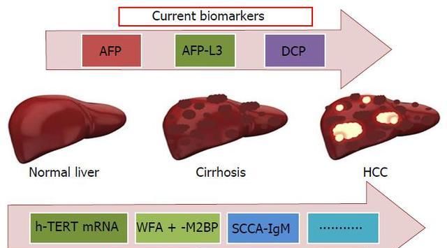 稳定的肝硬化出现病情变化，预示肝癌的发生？
