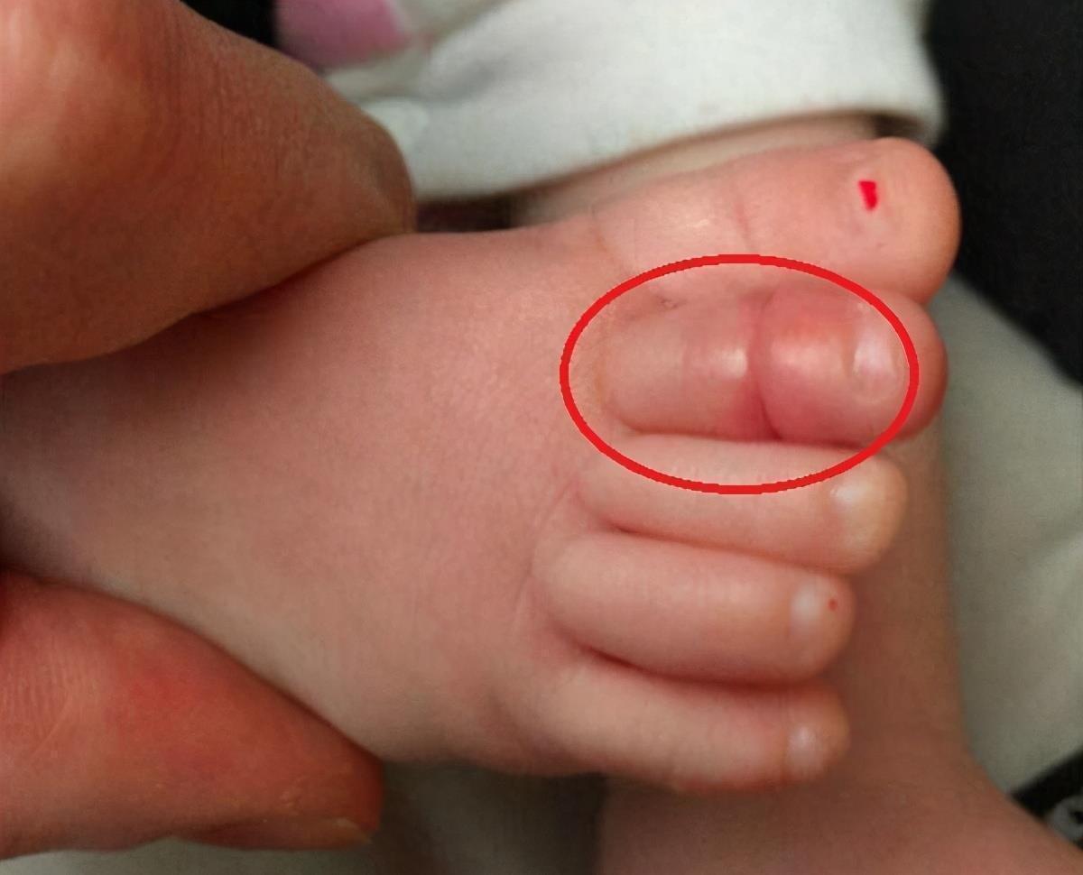 宝宝|1周岁宝宝脚趾进“虫”，宝妈急忙带娃就医，医生：来得及时