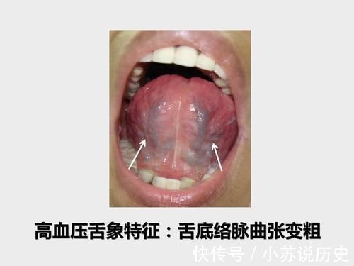 左手脉|50多岁大姐近来老是头晕,一量血压高压180,原来舌象早已预警