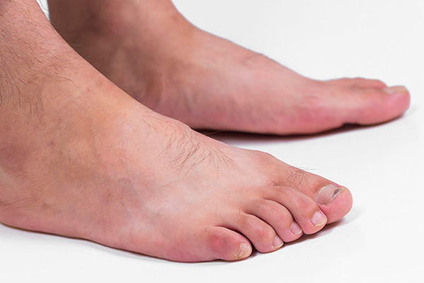 专家|癌症难以察觉专家双脚早就给出提醒,只是都被忽视了