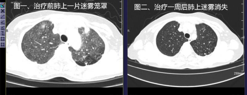 结核病|莫名发烧、胸闷，肺上还“起雾”，东西湖女子这一病根在蘑菇棚里找到了，狗身上、鸽舍里都有它