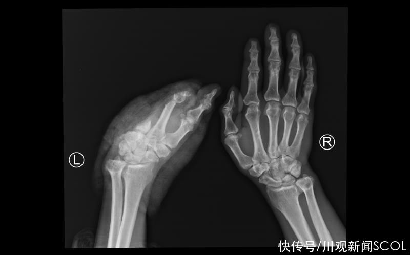 川观|四川省人民医院完成超长时间缺血断掌再植术
