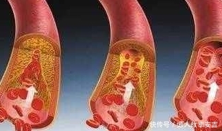 清理血管|血液粘稠如粥,多吃这2种食物,疏通血液,清理血管!