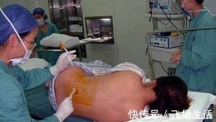 后遗症|剖腹产麻醉后,产妇有啥感觉,看经历过的妈妈们怎么说