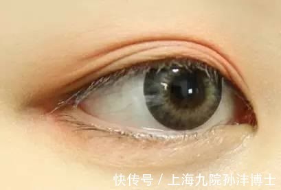 双眼皮 眼修复孙沣博士:双眼皮术后出现分叉能修复吗?