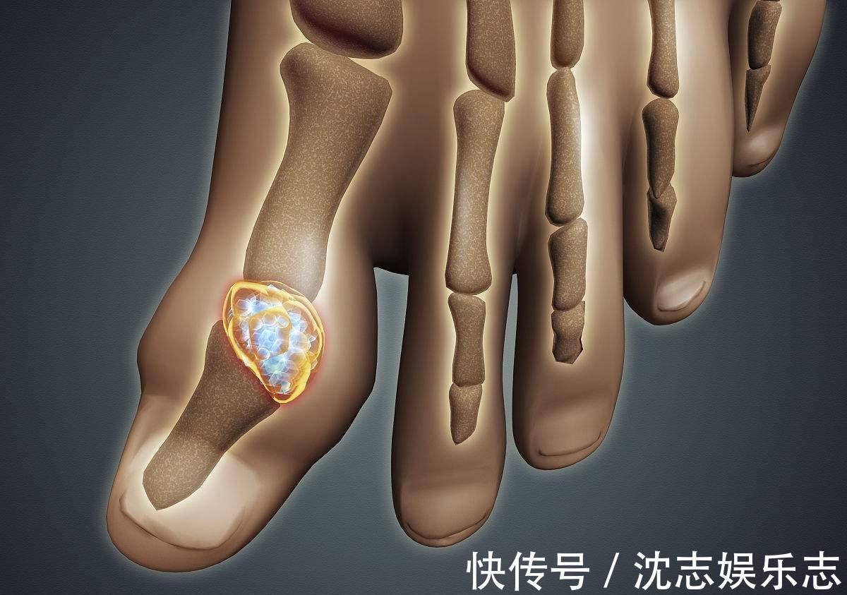 菊苣|已经被列入“黑名单”的3种嘌呤食物，经常吃，升尿酸又升血压