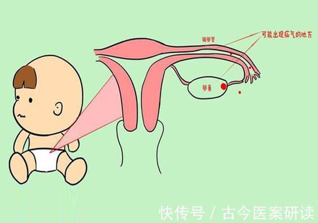 医生|小儿疝气是怎么一回事?医生:两种小儿疝气,家长要有所了解