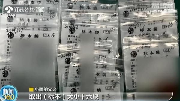 肿瘤|12岁女孩长“喉结”一查竟是甲状腺癌