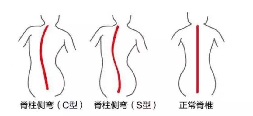 中医师|中医有办法丨脊柱弯成“S”型，孩子的这些不良体态，家长要注意
