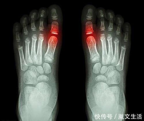 吃阿司匹林|长期吃阿司匹林,竟会出现这种副作用!该停药吗?知道就是赚到