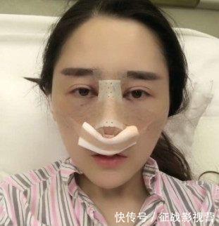 鼻子|女子被男友嫌弃“猪鼻子”,愤怒整容十几次,现在居然成陌陌女神
