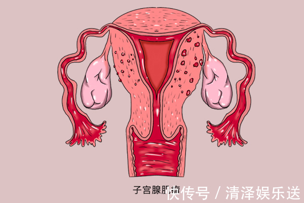 动物内脏|子宫内查出肌瘤,哪些食物能不吃就不吃了医生列出清单