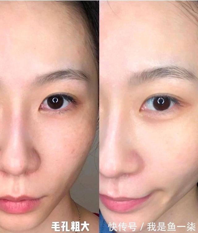 超光子 超光子嫩肤的第二年,我的皮肤有什么变化!