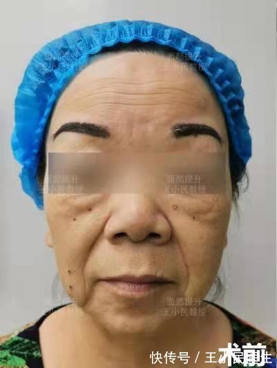 皮肤 拉皮除皱王小民教授:年纪大了还能做小拉皮吗,让她来告诉你!