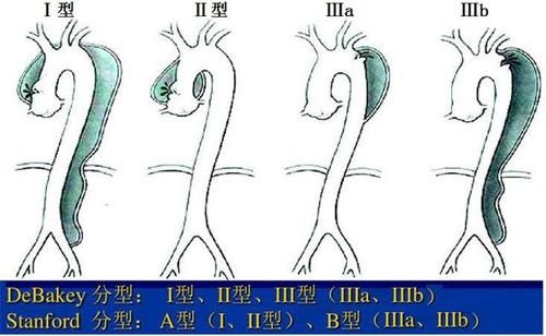 旋风|旋风杀手，主动脉夹层是什么病？