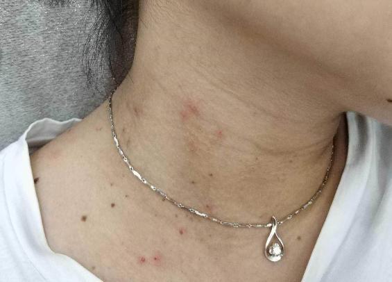 身体|脖子上长出了“小肉粒”是什么也许是身体向你发出的“暗号”