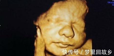 先天|孕检很正常,却生下畸形儿,医生这5种情况四维彩超也看不出