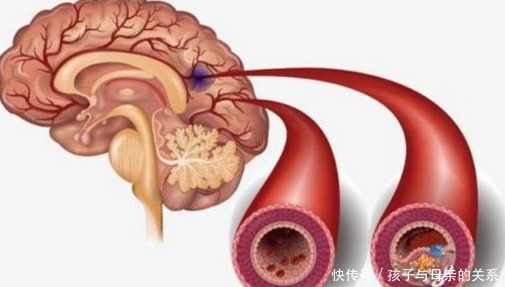  脑梗|为什么会发生脑梗？医生提醒：这些疾病不控制？拖成脑梗就晚了