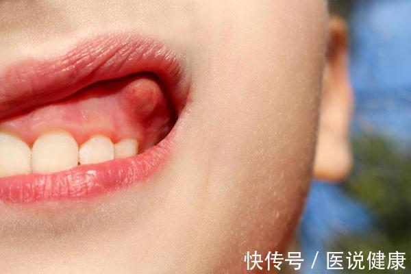 肿块|口腔癌发生时,会有5种异常表现,及时检查,避免错过治疗时期