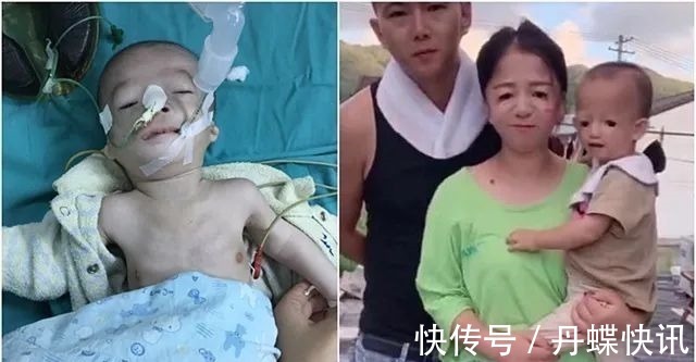 二胎|“鸟脸”妈妈执意生二胎,孩子不幸被遗传,一时的冲动毁孩子一生