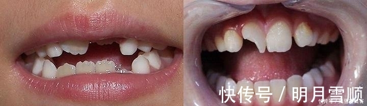 妈妈|17岁孩子长尖牙,妈妈以为是假的,亲手摸过后吐槽:像“吸血鬼”