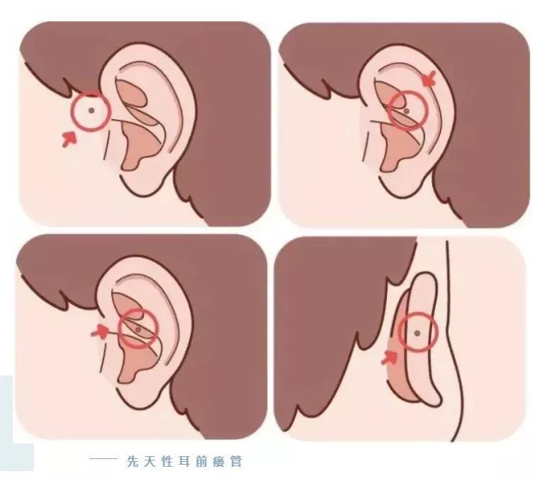 苗苗|听说耳朵长“聪明孔”,大富大贵还聪明?现实是,10岁女孩因它挨了刀