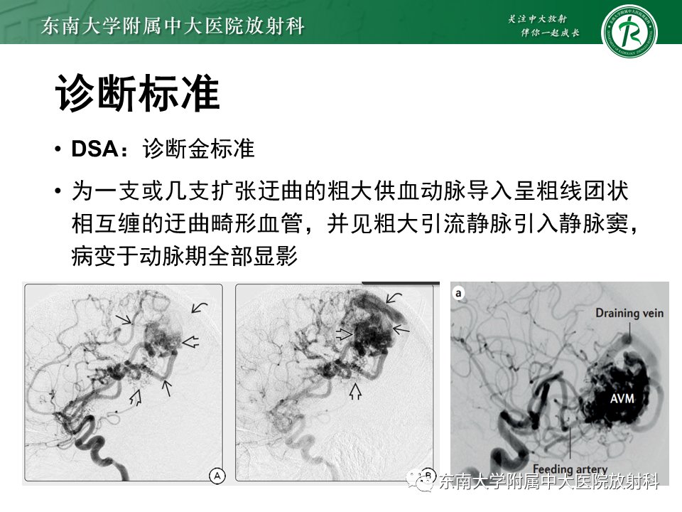 脑动静脉畸形 影像表现