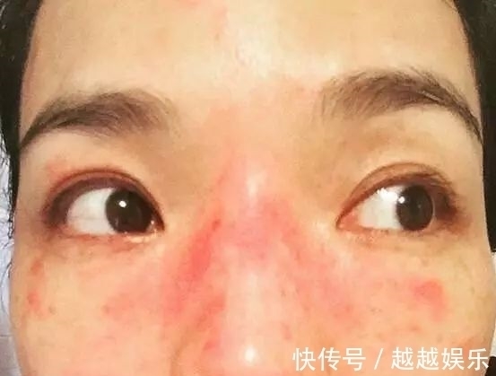 敏感性 护肤品没少用,但是皮肤越来越差?认清肤质才是护肤的关键!