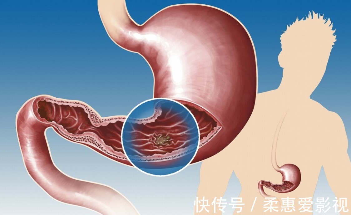 症状|糖尿病注意:这4个不易察觉的症状,也是糖尿病恶化的信号