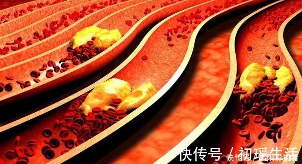 头痛|血管洗个澡，健康活到老，3件生活小事，让血管年轻20岁