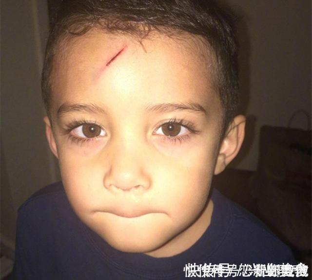 宝妈|男孩不小心磕破了额头,宝妈灵机一动,让娃变成了“哈利波特”