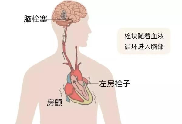 肺栓塞|它是心梗、脑梗的元凶，更容易找上这些人