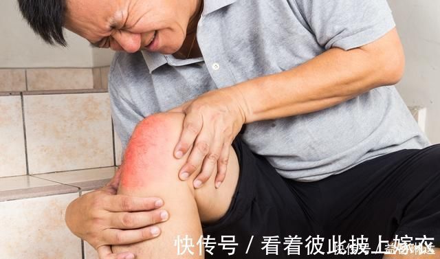 尿酸|尿酸高引起痛风，高尿酸是否需要服药呢？来看看医生怎么说