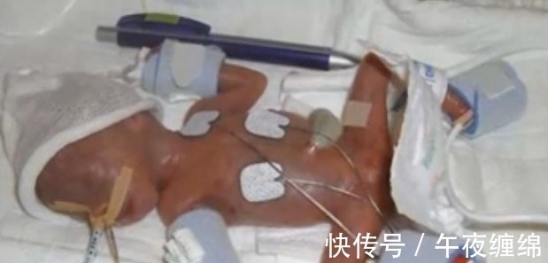 女子|女子生下3指大的婴儿,让在场所有医护人员都震惊了