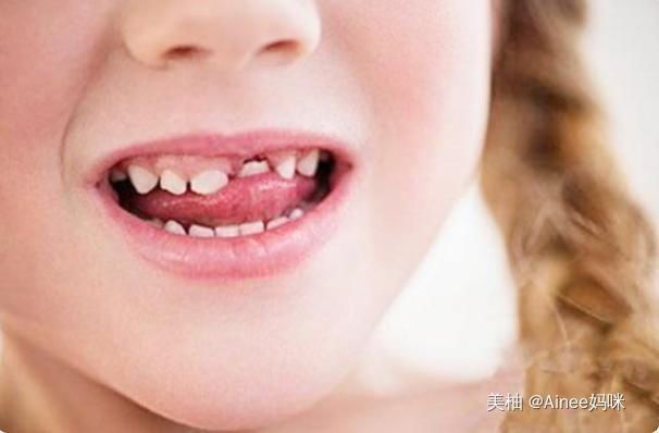 孩子乳牙整齐漂亮,换牙后却越来越“歪”可能是这几点没做好