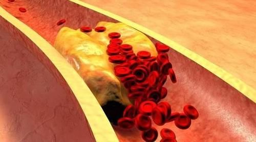 血脂|高血脂可以吃葡萄吗？医生建议：想要稳定血脂，5种水果少吃